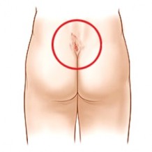 | Pilonidal Kyste | Solution Naturelle |